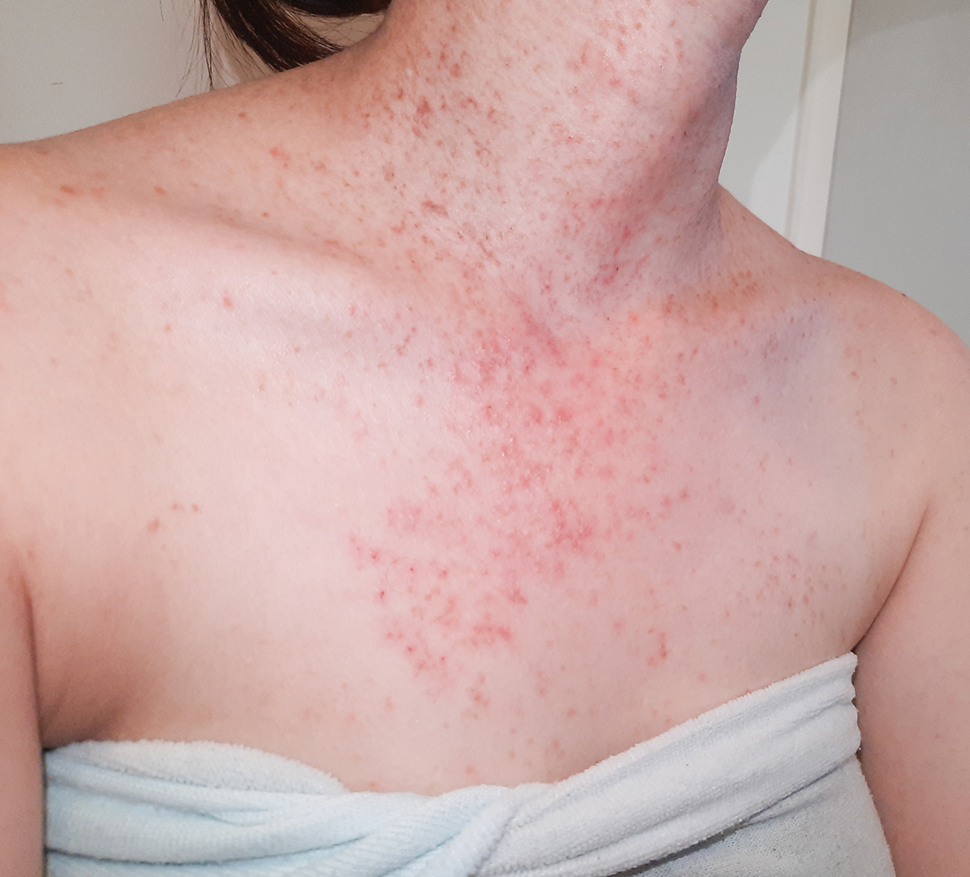 women with acne, Skin disease, Folliculitis inflammation, fungal infection