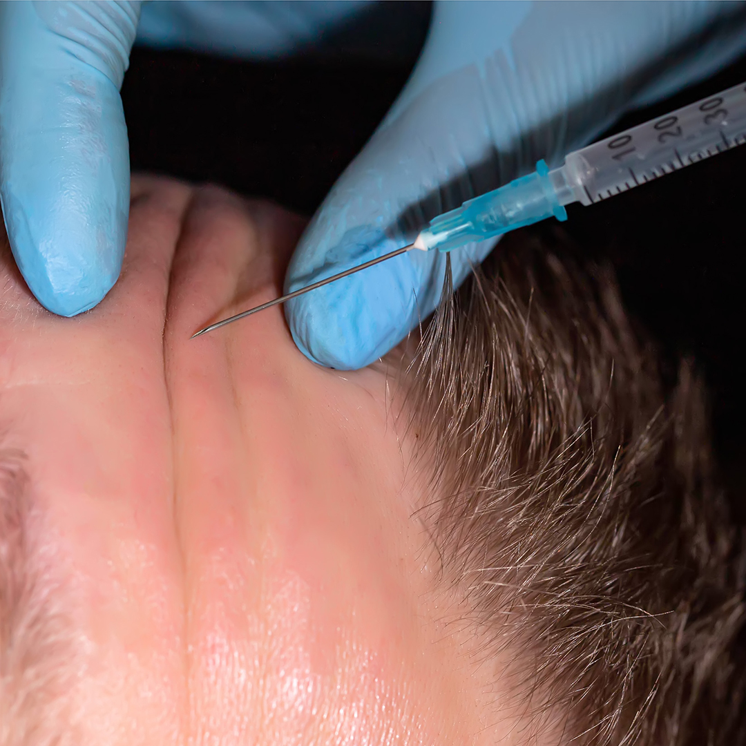 Doctor cosmetologist makes injections into the forehead against mimic wrinkles. Smoothing facial wrinkles in men